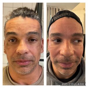 cosmelan pigment behandling